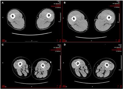 Spinal Cord Injury as a Model of Bone-Muscle Interactions: Therapeutic Implications From in vitro and in vivo Studies